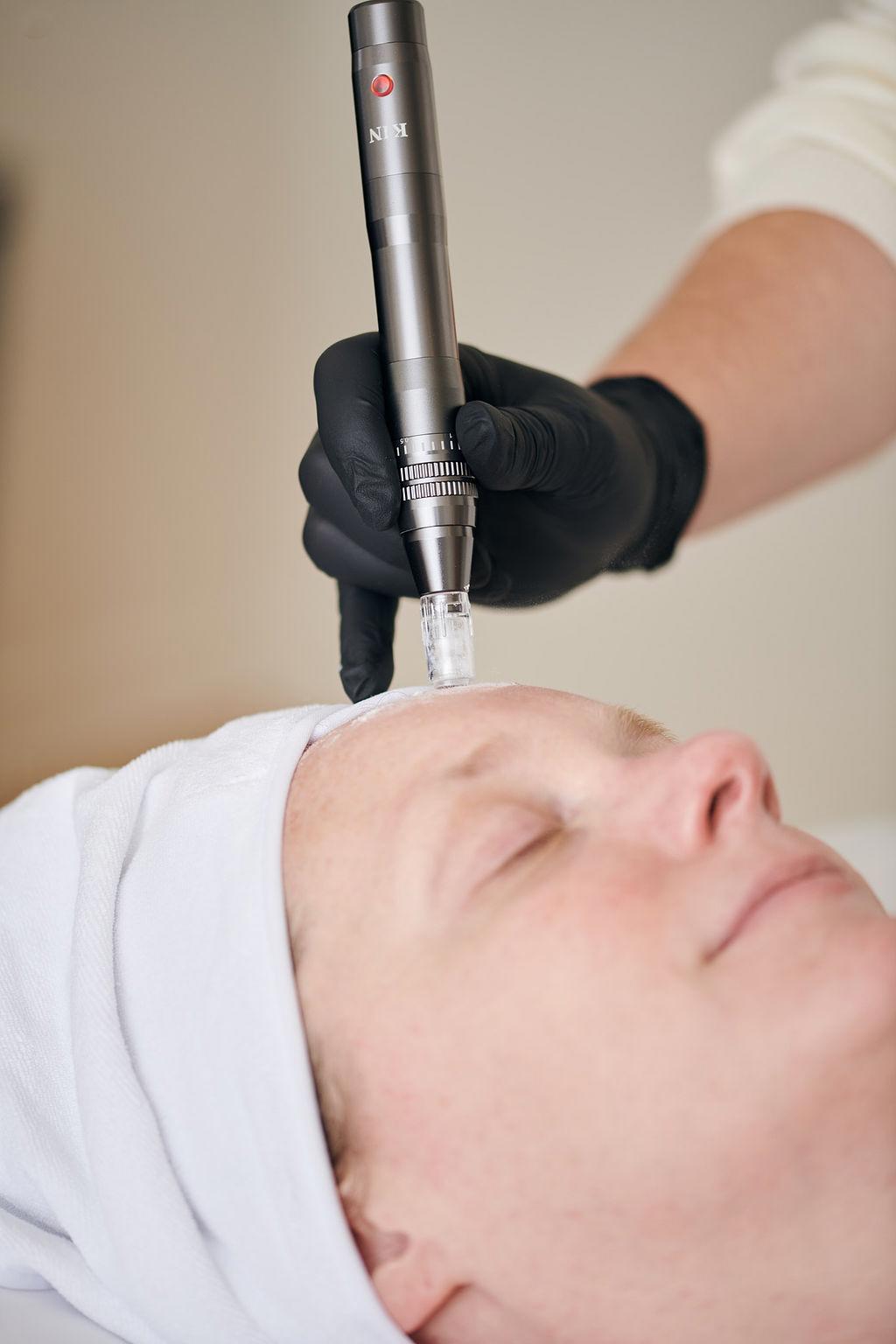 Microneedling vs. Nano Infusion: Which One is Right for Your Skin?